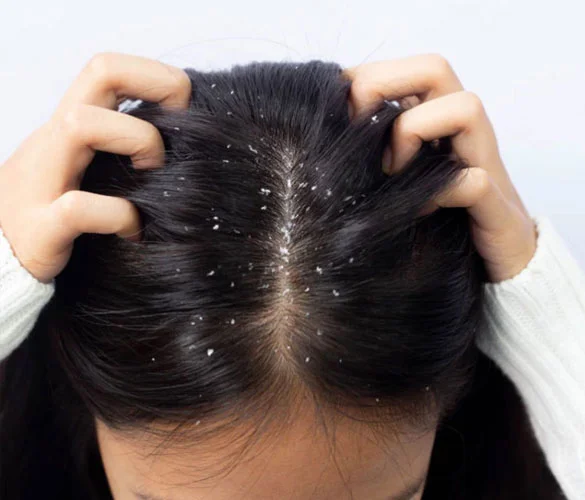 Dandruff treatment @ Advik Clinic