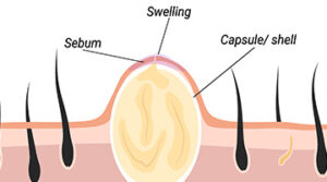 sebacious cyst