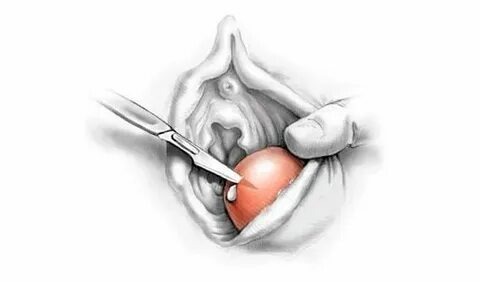 Bartholin Cyst