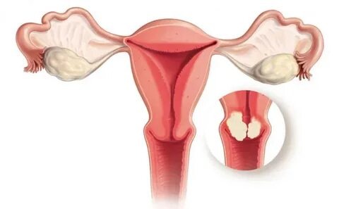 cervical erosion