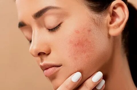 Hormonal acne natural treatment
