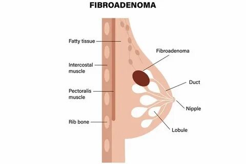 fibroadenoma breast