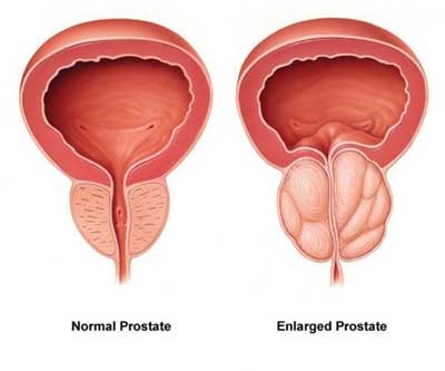Prostate Enlargement in men