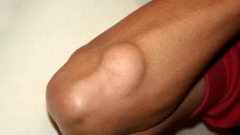 Lipoma treatment Advik Homeopathy Clinic