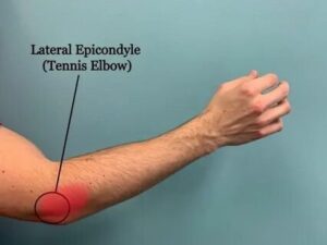tennis elbow