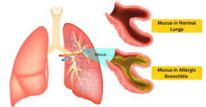 Allergic Bronchitis Treatment At Advik Homoeopathy Clinic