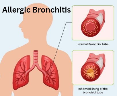 Allergic Bronchitis Treatment At Advik Homoeopathy Clinic