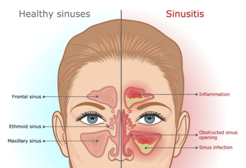 Sinusitis Treatment At Advik Homeopathy Clinic