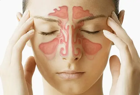 Sinusitis treatment at Advik Homeopathy