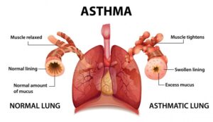 Bronchial asthama treatment at advik homoeopathy clinic