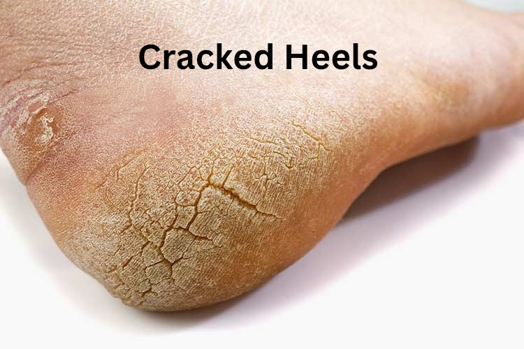 Cracked heels treatment at advik homoeopathy clinic