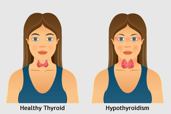 Hypothyroidism treatment at Advik Homoeopathy Clinic and Counselling centre