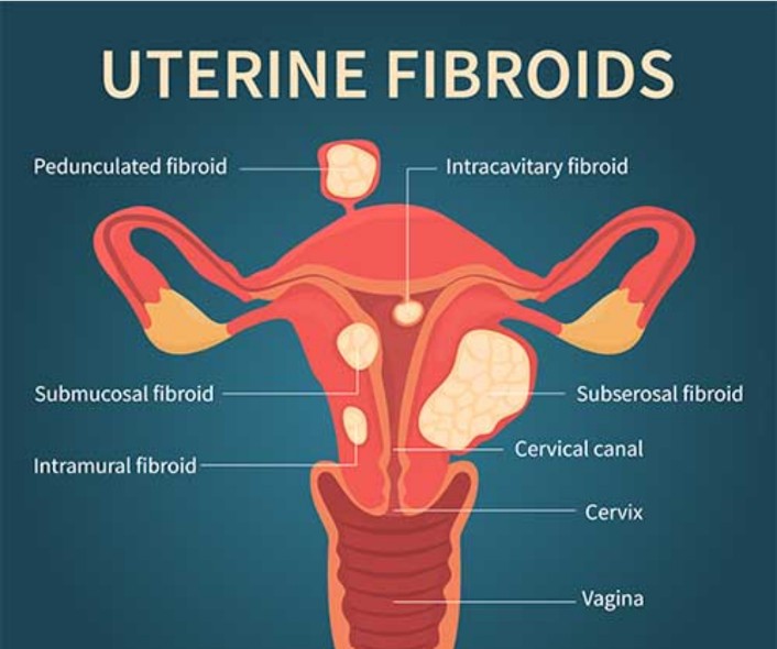 Fibroid treatment at advik homoeopathy clinic and counselling centre