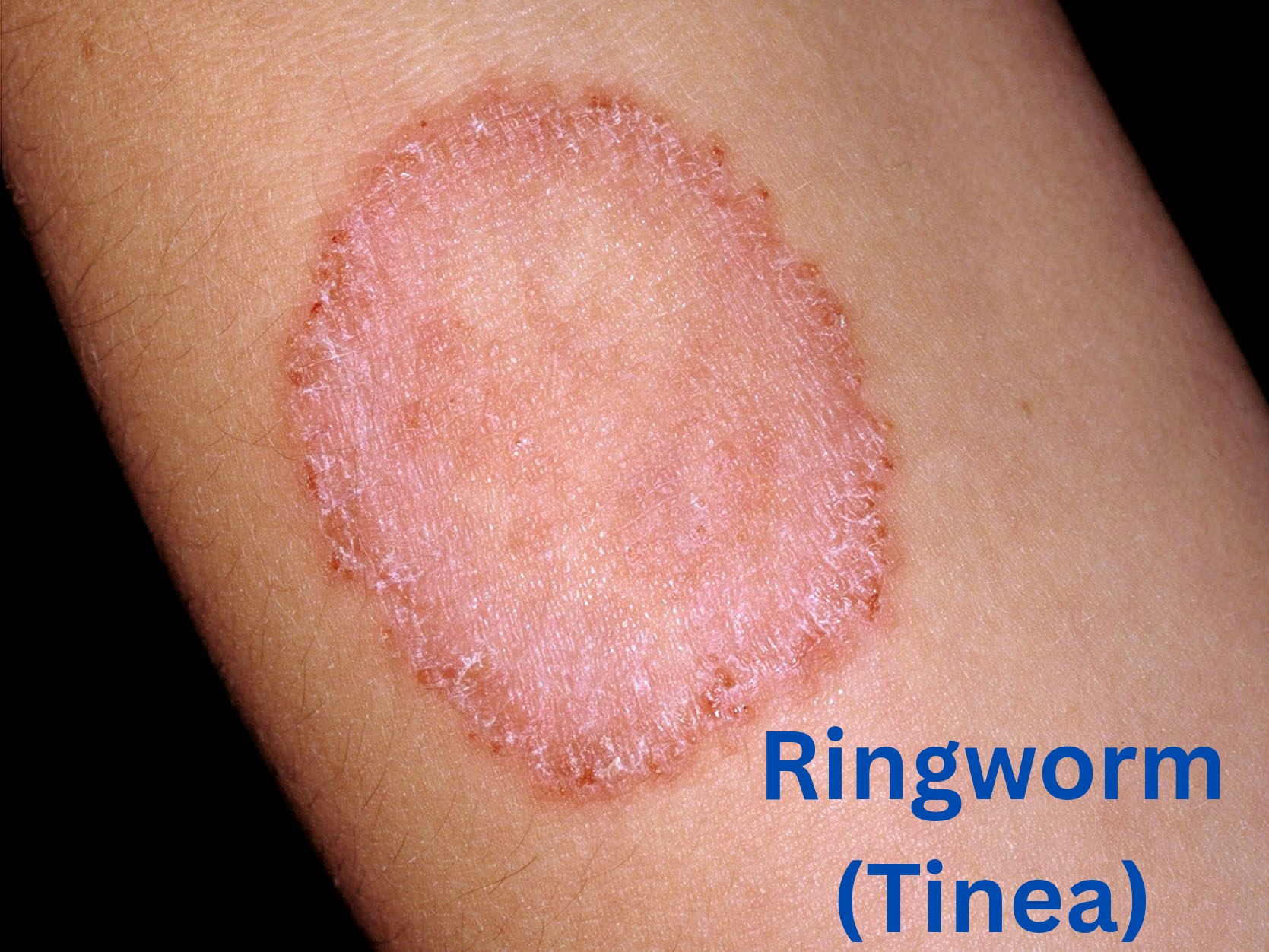 Ringworm Treatment At Advik Homoeopathy Clinic