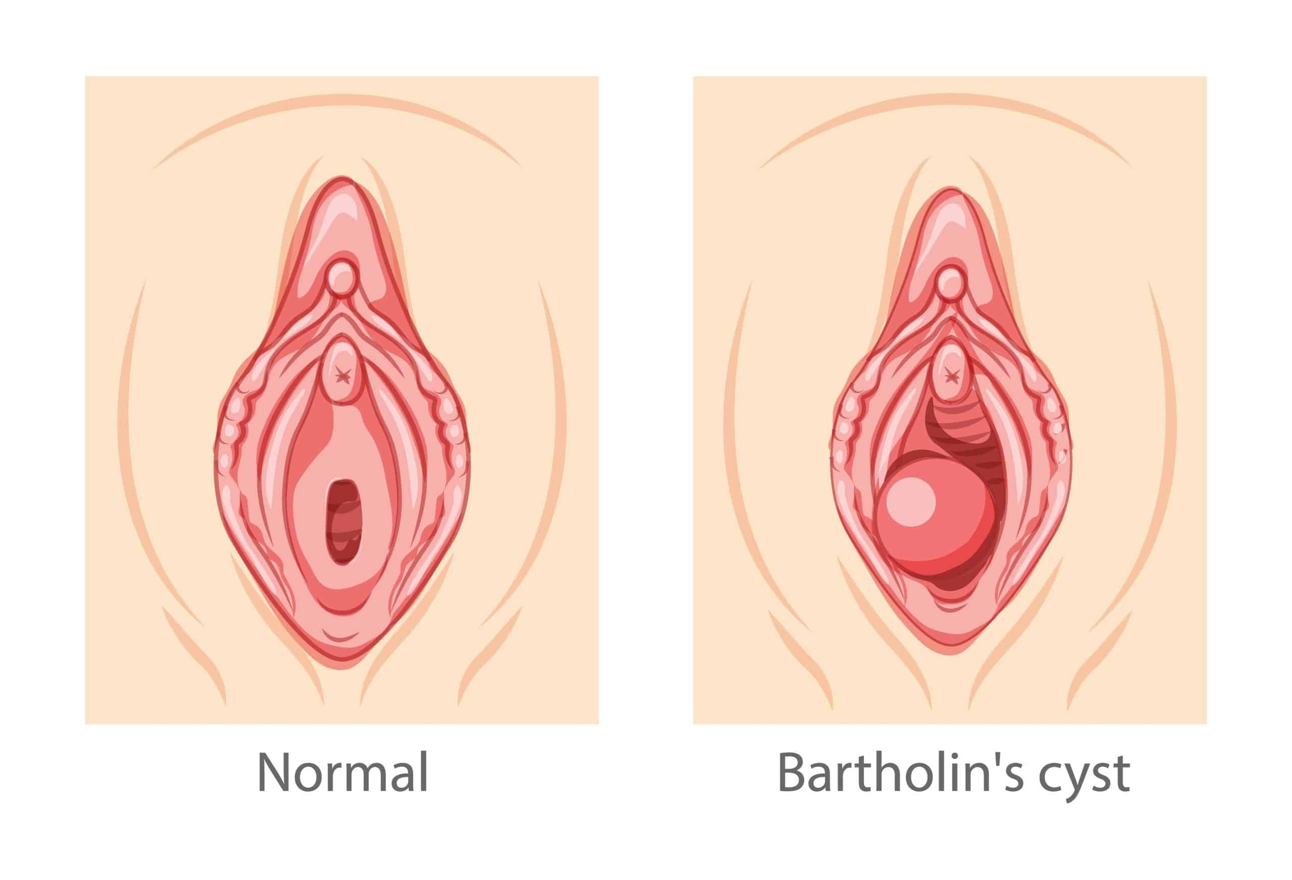 Brtholin cyst treatment at advik homoeopathy clinic