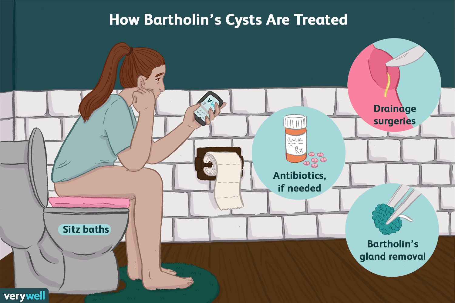 Brtholin cyst prevention plan at advik homoeopathy clinic