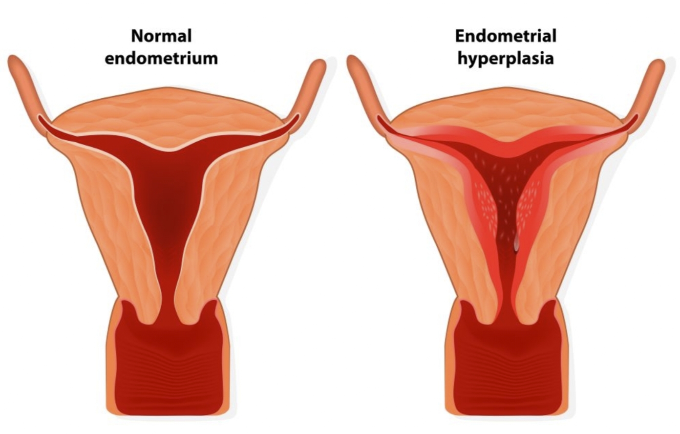 Endometrial Thickness treatment at advik homoeopathy clinic and counselling centre