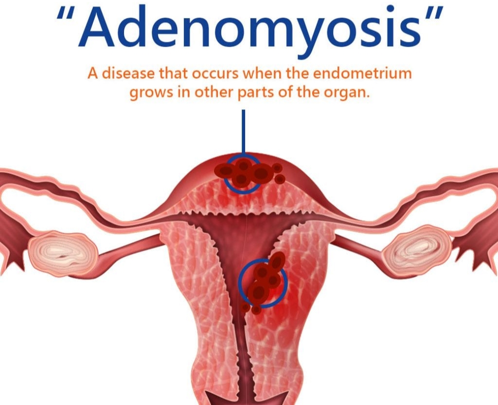 Adenomyosis Treatment At Advik homoeopathy clinic