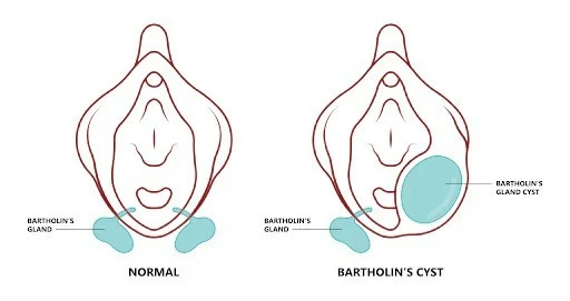 Brtholin cyst treatment at advik clinic