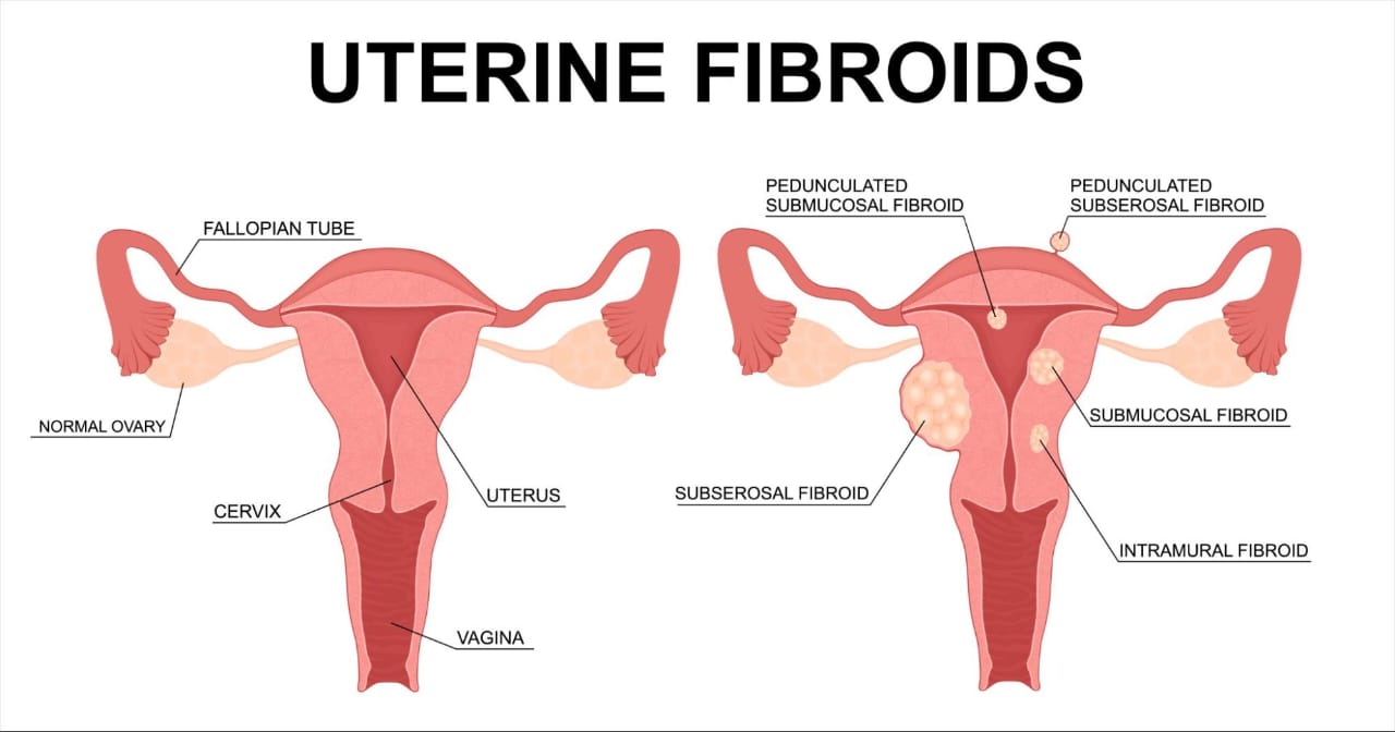Uterine fibroid treatment at advik homoeopathy clinic