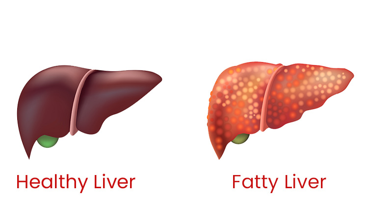 Fatty liver disease treatment at advik homoeopathy clinic